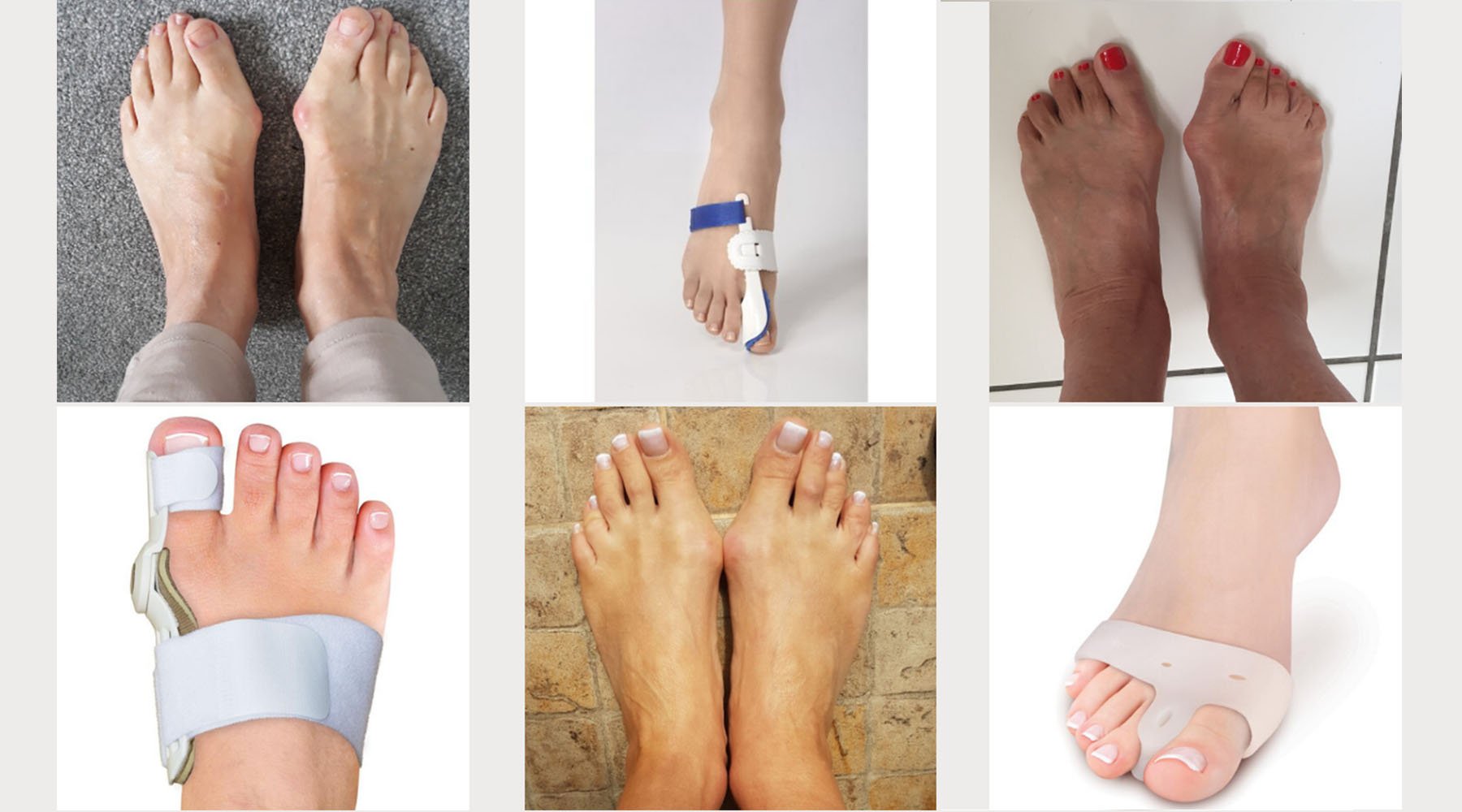 collage showing bunions and various bunion correctors including splints and toe separators