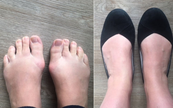 customer review of flat shoes for bunions and wide feet 