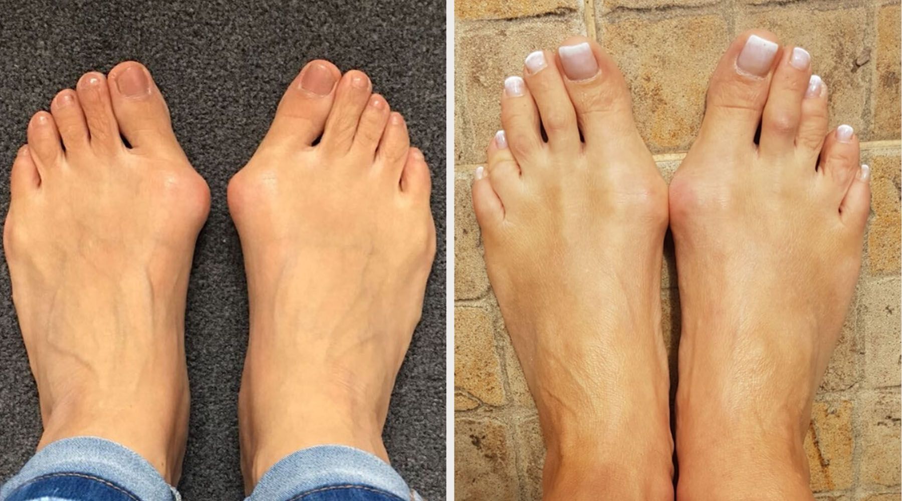 curing bunions by jennifer bailey calla shoes