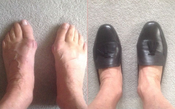 feet in and out of shoes for bunions