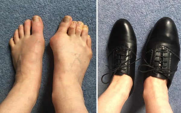 review of calla shoes for bunions by fiona