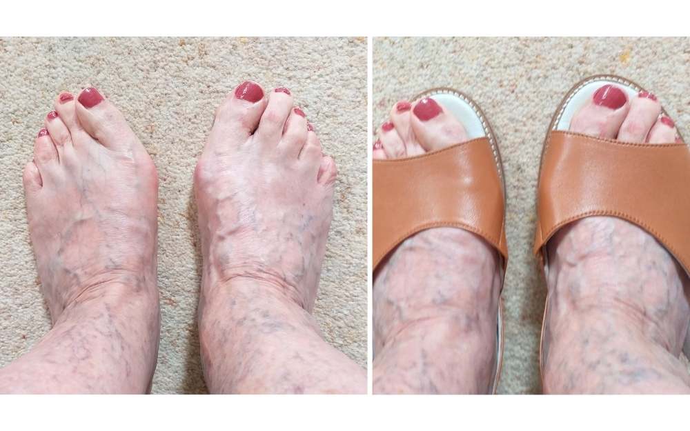 customer review of calla shoes for bunions