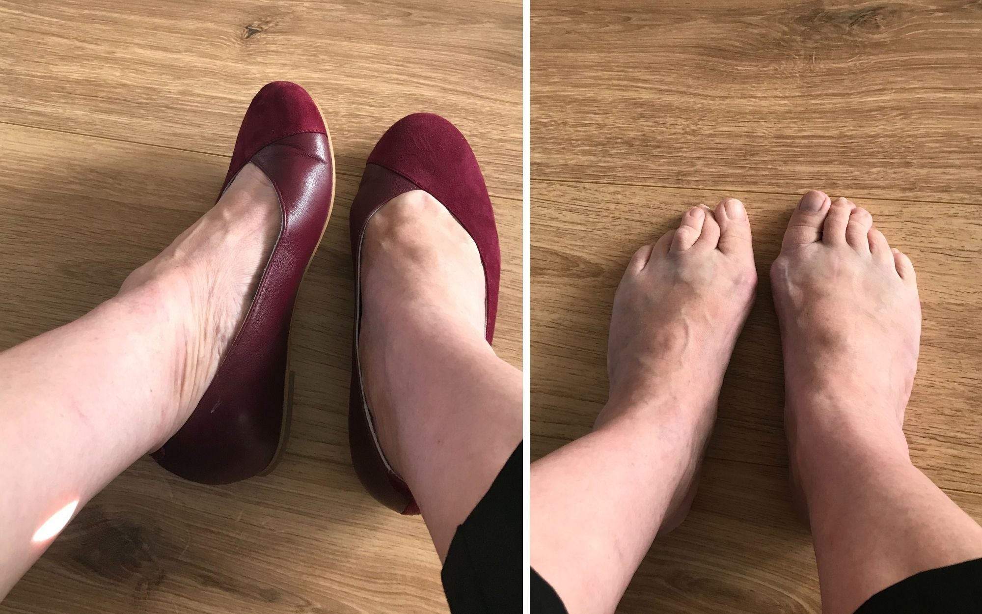 customer review of calla shoes for bunions