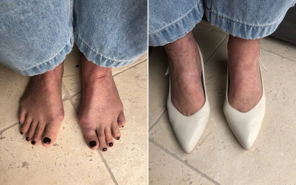 feet with bunions with and without the shoes on