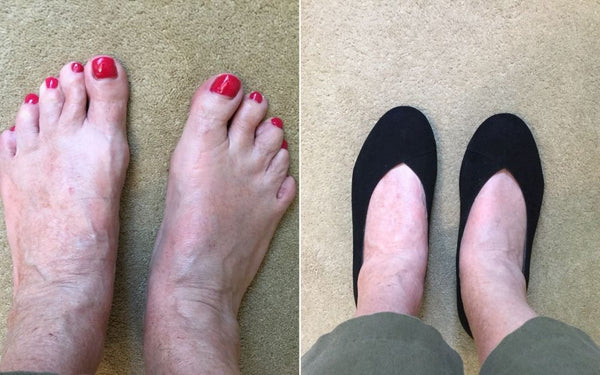 review of calla shoes for bunions by yvonne