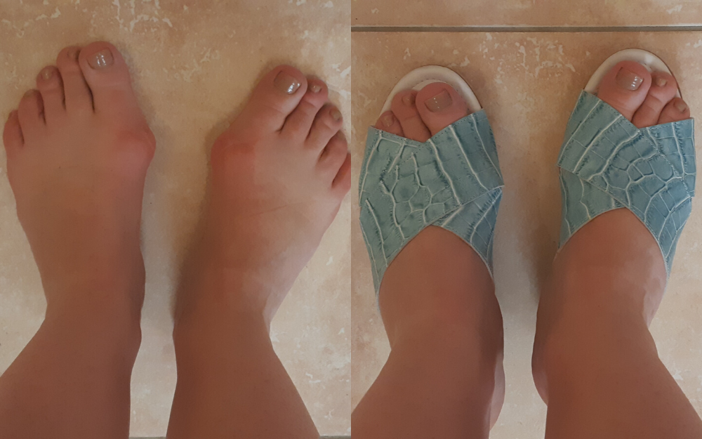 review of calla shoes for bunions