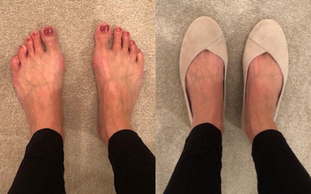 review of calla shoes for bunions