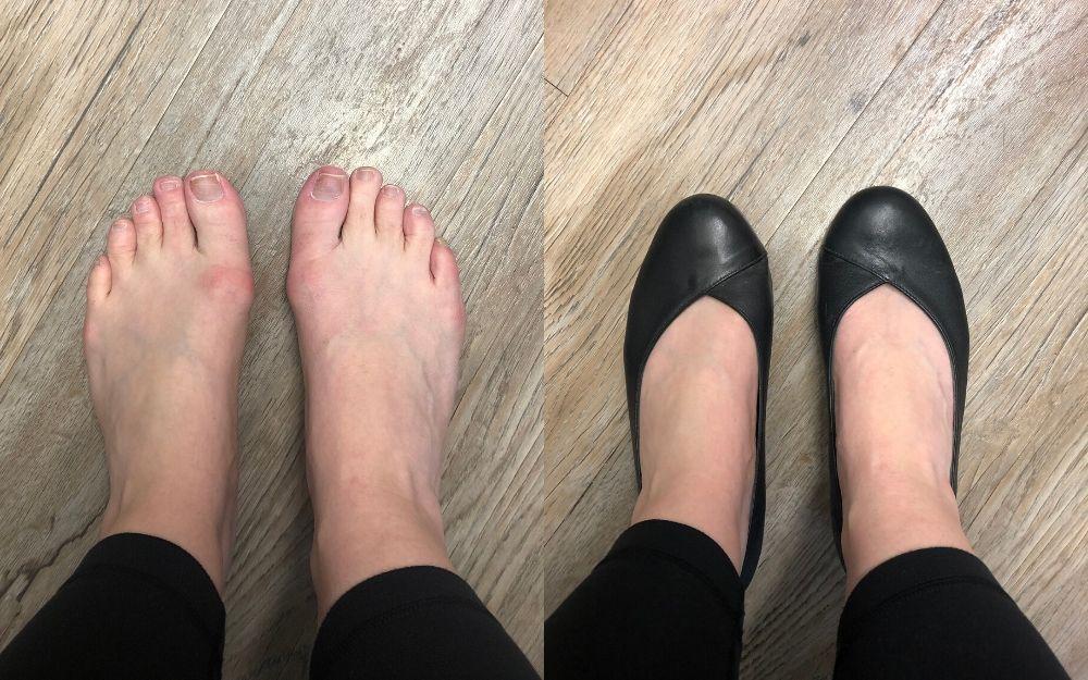 review of calla shoes for bunions