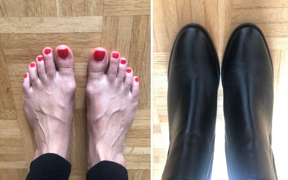 feet with bunions side by side with boots