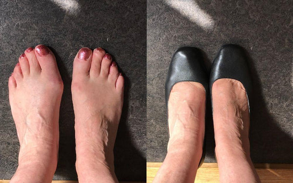 feet with bunions wearing calla shoes