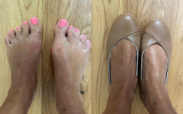 feet with bunions and feet in calla shoes