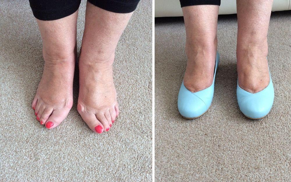review of calla customer wearing blue flats for her bunions