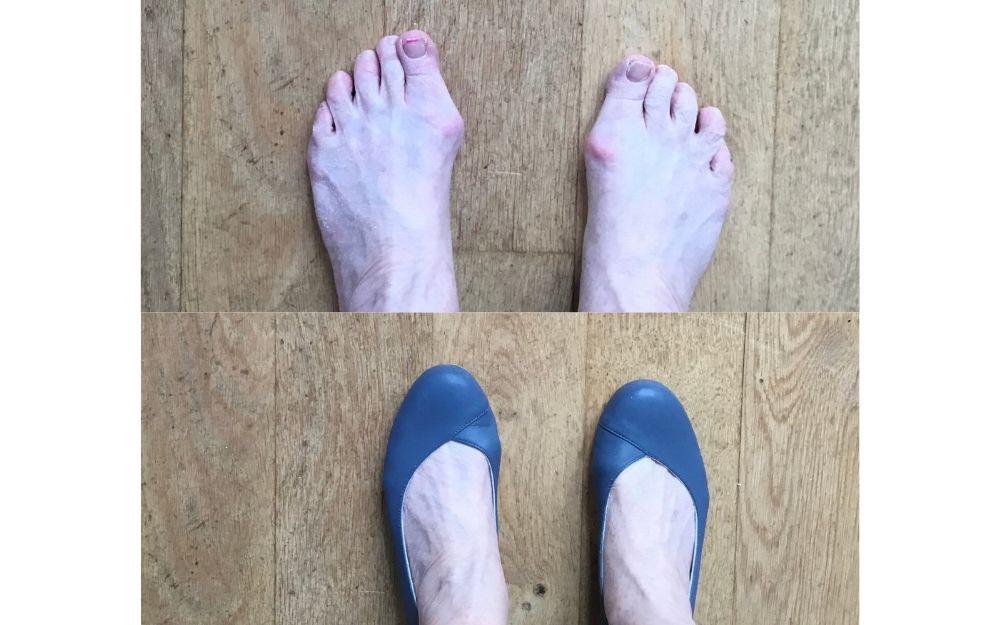 photo review of calla shoes for bunions